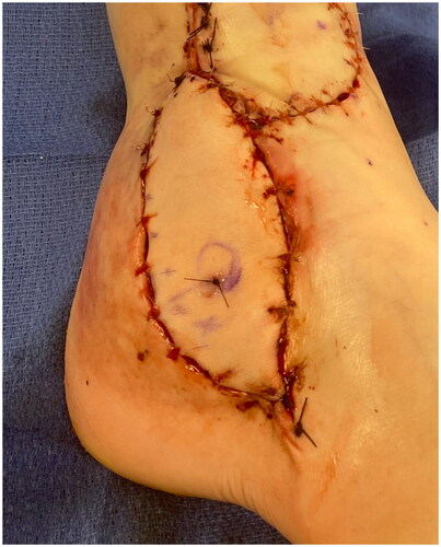 Figure 2. Right lower extremity wound appearance after radial forearm free flap. The proximal and distal portions of the defect were approximated with 4-0 Nylon sutures in a horizontal mattress fashion. The flap was inset with interrupted, simple 3-0 Monocryl sutures. The incision over the recipient anterior tibial artery was closed with interrupted, simple 3-0 Monocryl sutures. Nylon suture in the free flap marks the site at which doppler monitoring was performed over the flap postoperatively.EI