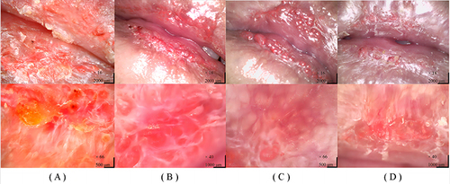Figure 2 Various stages of treatment for the Case. (A) Baseline; (B) After one month of treatment with 2% Crisaborole Ointment; (C) After two months of treatment with 2% Crisaborole Ointment; (D) After undergoing one session of Q-switched 532nm Nd:YAG laser treatment.