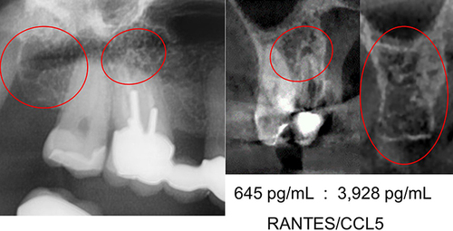 Figure 3 Left window shows OPG with teeth 16, 17 and alveolar region 18 up to and including retromolar region 19. Apical region of 16 and regions 18/19 are marked with red circles and are radiographically largely inconspicuous. Centre window shows frontal section CBCT/DVT at 16 with clear AP at buccal root. Right radiographic image shows frontal section CBCT/DVT at 18/19 with clear partial resolution of the cancellous bone structure. Picture below centre and right radiographic image displays the results of R/C expression in AP 16 and in BMDJ/FDOJ 18/19 for comparison. Figure Indicators: Red circles mark inflammatory areas of alveolar bone.