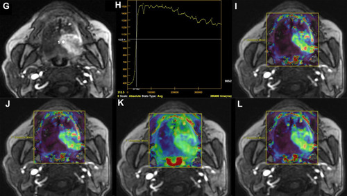 Figure 2 Picture of a typical tongue cancer patient. Dynamic enhanced image (G) showed obvious uneven enhancement with clear boundary. The selected dynamic enhancement curve in ROI presents a clearance type (H); i~l are the corresponding function maps of Ktrans, Kep, CER and IAUGC, respectively, showing that each perfusion parameter of the lesion was significantly higher than that of the adjacent tissues, and the distribution of each perfusion parameter in the lesion was uneven.