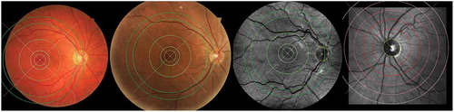 Figure 11. OD and fovea detection results and defined region of interest around OD or fovea centre.