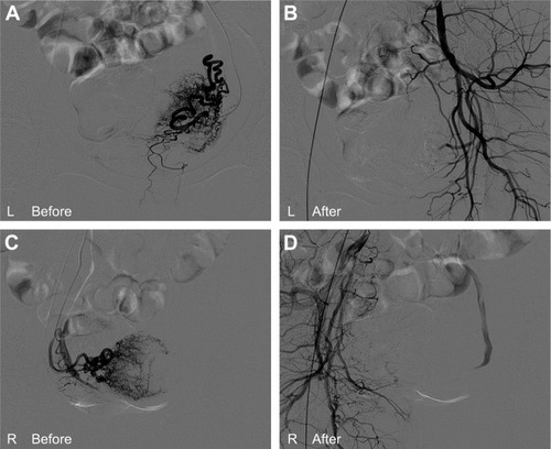 Figure 2 Digital subtraction angiogram images from the patient with CSP who was treated using transcatheter uterine arterial embolization.