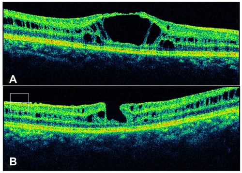 Figure 2 Spectral domain optical coherence tomography images of Case 1 taken through the center of the fovea. The right eye (A) demonstrates a large central cyst that extends from the nerve fiber layer to the outer retina. Both the right and left (B) eyes demonstrated the presence of cystic spaces and splitting of the retina in multiple layers, including the nerve fiber layer, the inner plexiform layer, and the outer plexiform layer.