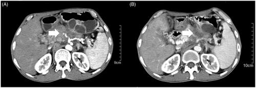 Figure 4. CT images from before (A 24 February 2014) and after treatment (B 11 April 2014). The longest diameter of the primary mass (white arrow) decreased from 69 mm to 62 mm (decreased by 11%) after three HIFU treatments.