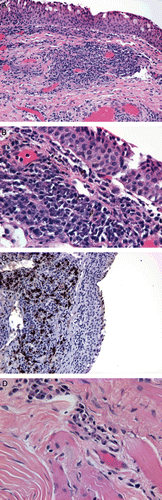 FIGURE 3  Histopathology of conjunctival and inferior rectus muscle biopsies. (A) Conjunctival lymphoplasmacytic inflammation and sclerosis (40×). (B) Higher magnification reveals predominance of cytologically bland plasma cells (100×). (C) Conjunctival IgG4+ plasma cells (brown) are markedly increased (40×). (D) The inferior rectus biopsy reveals dense fibrosis of striated skeletal muscle with a predominantly plasmacytic infiltrate (100×).