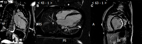 Figure 2 (A) A 21-year-old male patient’s two-chamber PSIR image shows LGE located at the sub-epicardium. (B and C) Same patient’s short-axis and four-chamber PSIR image show LGE located at the sub-epicardium of lateral wall, mid-myocardium of septal wall.