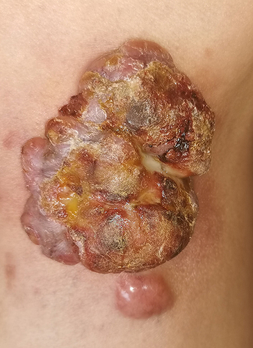 Figure 2 Clinical photograph of the patient: after topical injections of compound betamethasone injections 1 mL x 4 times.