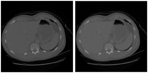 Figure 2. Denoising of liver CT image.