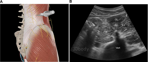 Figure 4 (A) Scanning position. The figure is a modified excerpt from 3Dbody, with permission from 3Dbody (Shanghai) Digital Technology Co., Ltd (www.3Dbody.com). (B) SCN block technique at the lateral margin of the erector spinae muscle. The figure is a modified excerpt from 3Dbody, with permission from 3Dbody (Shanghai) Digital Technology Co., Ltd (www.3Dbody.com).White arrow denotes injection site.