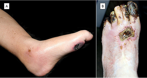 Figure 2 Neuroischaemic (A) showing a typical pressure area ulcer combined with lower limb features suggestive of chronic ischaemia; and Ischaemic (B) lesions on the left toes with large areas of gangrene.