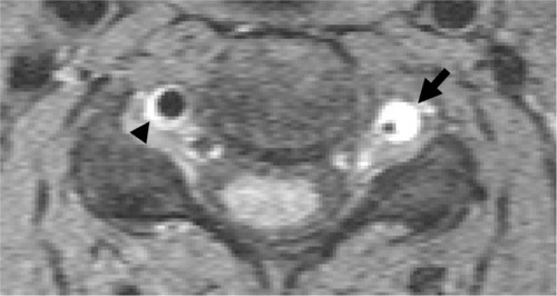Figure 4 The axial fat-saturated T1 MRI sequence shows dissection of the left (arrow) and dissection of the right VA (arrow head).