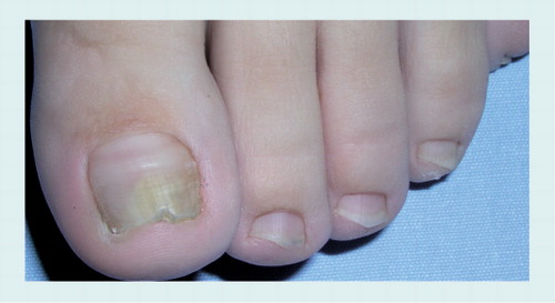 Figure 8. Traumatic onycholysis of the left toenail in a 12-year-old girl: the subungual space is white and there is no hyperkeratosis.