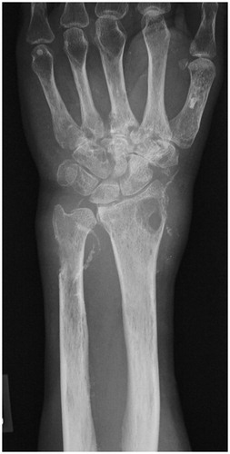 Figure 1. Preoperative radiograph showing an osteopenia with marginal erosions and diffuse lytic lesions in the carpal bones, base of the metacarpal bones, and distal ends of the radius and ulna.