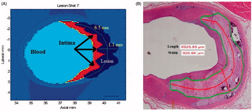 Figure 4. Correlation between the simulation results and histology. (A) Simulation result of the thermal dose within the targeted atheromatous plaque. Note the intact intima (black arrows) overlying the targeted plaque. (B) Thermal damage within the targeted plaques as shown from histology (H&E stain).