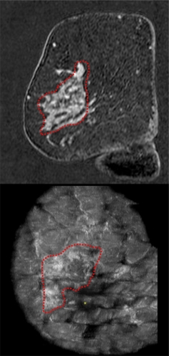 Figure 9 Clinical example of an invasive lobular breast cancer. In order to estimate the extension of the lesion, we performed both MRI and the automated breast volume scanner. The coronal planes of both imaging modalities demonstrated a correlation in the measurements of the lesion.