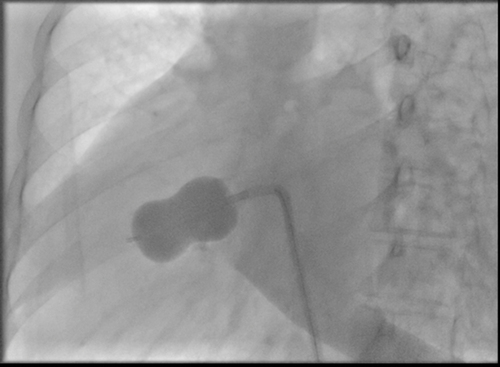 Figure 5 Fluoroscopic image of balloon dilatation of the mitral valve.