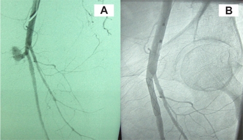 Figure 1 Case 1. A) Extravasation from the superficial femoral artery just beyond the common femoral bifurcation. B) successful control of the bleeding after stent deployment.