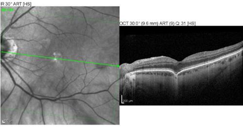 Figure 4 SD-OCT of conforming FCE in the macula shows the outer retinal layers in apposition to the area of focal choroidal concavity.