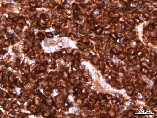 Figure 2. Immunohistochemical study of lysozym shows strong diffuse staining of the blastic cells (original magnification 40×).