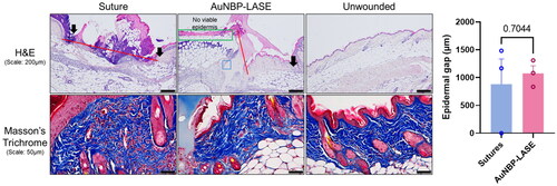 Figure 4. Histological analyses of mice incisions closed with sutures and AuNBP-LASE on day 2 post wounding. Representatives of n = 3 independent images are shown here; other images are shown in Supplementary Figure S4. (Top) Hematoxylin and eosin (H&E) staining (red lines indicate the dermal gap, black arrows indicate the epidermal edge, blue box shows the area of glue integration with the tissue, and green box illustrates the effect of laser-induced hyperthermia on dermal collagen) and (bottom) Masson’s trichrome staining. (Right) Quantification of epidermal gap for incisions closed using sutures and AuNBP-LASE.