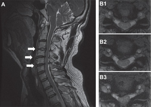 Figure 2 Cervical spine magnetic resonance imaging sagittal (A) and axial views showed herniation of the intervertebral disk in C3/4 (B1), C4/5 (B2), and C5/6 (B3) shown by arrows in (A), with a compression of the ventral surface of the spinal cord.