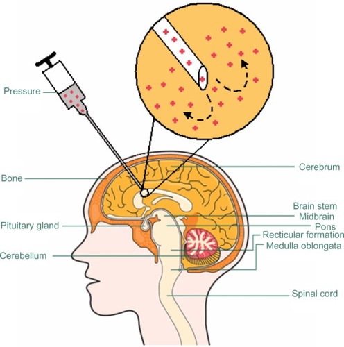 Figure 6 Illustration of convection-enhanced delivery. Using a microinfusion pump, molecules are infused through a cannula inserted into the target. Continuous positive pressure, driven by the micro-infusion pump, is maintained at the lip of the cannula. This pressure gradient provides the convective flow to push the molecules further away from the cannula lip.