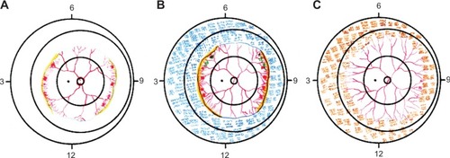 Figure 1 Fundus sketches of the left eye obtained by indirect ophthalmoscope.