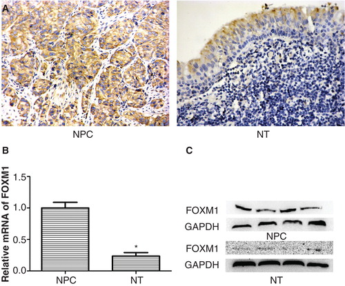 Figure 1. Expression of FOXM1 in NPC and normal nasopharyngeal tissues (NT). A: Overexpression of FOXM1 in NPC and low expression in NT as evidenced by immunohistochemical staining. B: Relative FOXM1 mRNA levels in NPC and NT were determined by qRT-PCR. C: Overexpression of FOXM1 in NPC and low expression in NT were determined by Western blot. Experiments were independently repeated three times. *p < 0.05.