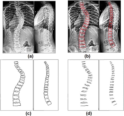 Figure 3. Subject-1 (a) Enhanced x-ray (b) Segmentation (c) Morphological operation (d) Edge extraction.