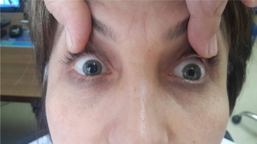 Figure 1 Mydriasis after botulinum toxin injection in the right eye.