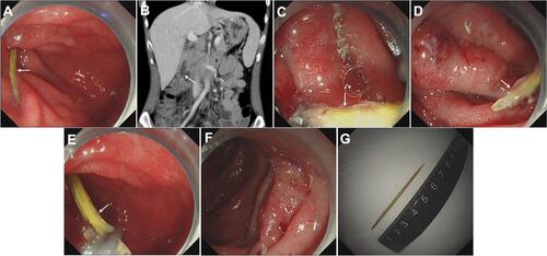 Figure 2 Case illustration of endoscopic removal of a toothpick. (A) Endoscopic image showing impaction of a toothpick in the descending duodenum. (B) Computerized tomography showing the toothpick. (C) Extraction of one side of the toothpick using grasping forceps. (D) Exposure of one side of the toothpick, and we could see the wound surface impacted. (E) Extraction of the other side of the toothpick. (F) Oozing of the wound surface after extraction of the toothpick. (G) The extracted toothpick. The white arrow points to FBs.