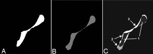 Figure 3.  A–C. Transversal 2-D slices extracted from the binary recipient (A) and the binary allograft after registration (B). The term “binary” is related to the fact that only 2 kinds of voxels can be found in these volumes (“1” where bone is present, “0” for the background). At the end of the registration process, an overlay volume (C) is automatically produced merging the 2 binary volumes (A and B). Different gray values are attributed to the voxels in the overlay: dark gray where the allograft is overlapping the recipient (panel C, 1), light gray where the allograft is larger than the recipient (panel C, 2), and white where the recipient is larger than the allograft (panel C, 3).