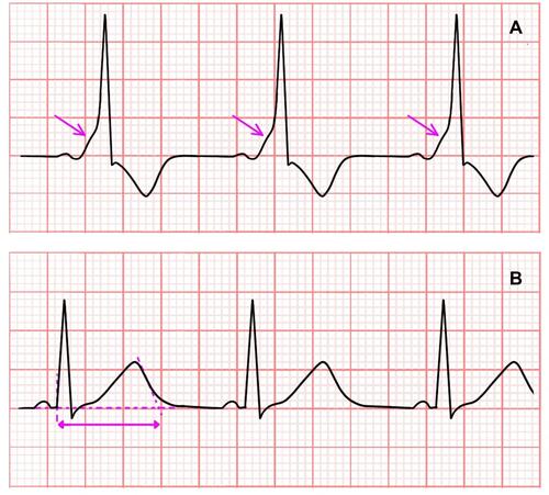 Figure 3 (A) Wolff-Parkinson-White (WPW) syndrome (pink arrow: Delta wave). (B) Long QT interval. (pink arrow: QT interval).