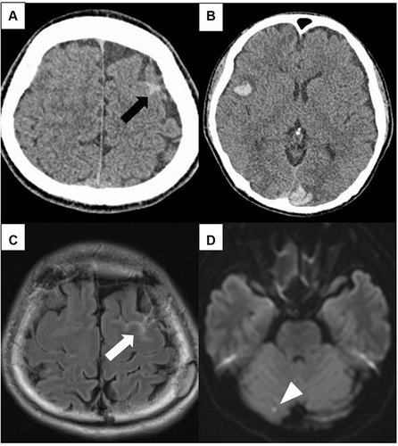 Figure 1 Contrast-enhanced CT and MRI of the head on admission. Black arrow indicates cortical convexity subarachnoid hemorrhages of the left frontal lobe (A), multiple subcortical hemorrhages are also observed (B), MRI on T2 FLAIR reveals a hemorrhage (white arrow) in the left frontal lobe gyrus (C), and diffusion-weighted MRI also reveals acute brain infarction (white arrowhead) in the right cerebellar hemisphere (D).