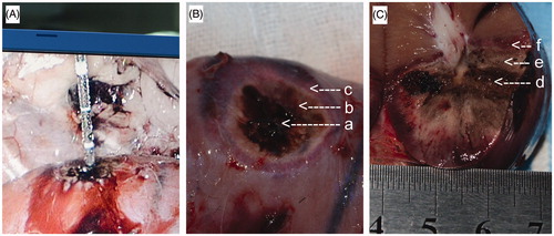 Figure 1. Characteristics of microwave ablation. (A) Laparoscopic ablation procedure. (B) Kidney specimen after ablation (a: thick black, b: pale, c: dark red). (C) Sectional view of the ablation lesions (d: carbonization zone, e: coagulation zone, f: inflammatory reaction zone).