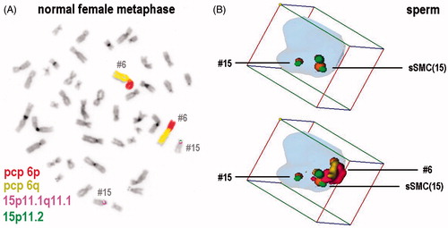 Figure 1. Example for a probeset used for fluorescence in situ hybridization (FISH) in the present study on a normal diploid female metaphase (A) and in a human sperm with a small supernumerary marker chromosome (sSMC) 15. (A) All probe sets used were designed as shown exemplarily for combination of chromosome-6- and -15-specific probeset. Here this probeset was hybridized on a normal diploid female, peripheral blood derived metaphase spread: partial chromosome paints (pcp) for short (p) and long (q) arm identify chromosome (= #) 6; a combination of an alphoid centromeric probe for 15p11.1 to 15q11.1 and a satellite III probe for 15p11.2 was applied to stain chromosome 15. (B) An example of how 3D-FISH analyses looked like using Cell-P-program (Olympus) is shown. The same sperm is shown twice. In the upper lane only chromosome 15 and sSMC(15) are depicted; as only probes covering overall 15p11.2 to 15q11.1 were applied the normal chromosome 15 shows a smaller staining than the sSMC(15) and both can be distinguished. In the lower lane all color channels used are depicted, i.e., the sSMC(15) and chromosomes 15 as well as 6 can be identified. Chromosomes 6, 15, and sSMC(15) were positioned in periphery. Chromosome 15 is located towards the sperm tail, chromosome 6 towards the head. Chromosome 6 and sSMC(15) are localized in close proximity, but also chromosome 15 and sSMC(15) are located together and not on opposite sides of the nucleus.
