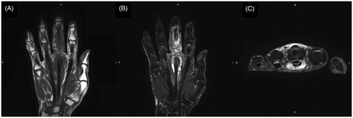 Figure 4. Magnetic resonance imaging of the hand. There is evidence of tenosynovitis of middle finger. (A) T1-weighted coronal image. (B) T2-weighted coronal image. (C) T2-weighted axial image.