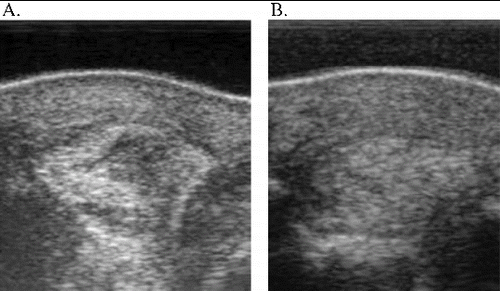 Figure 3. Ultrasound images of case 6. Lateral branch SL left front – 7.5 MHz. (A) Two weeks post-injury/moment of eUCB-MSC injection. (B) Eighteen weeks post-injury/16 weeks after eUCB-MSC injection – positive result.