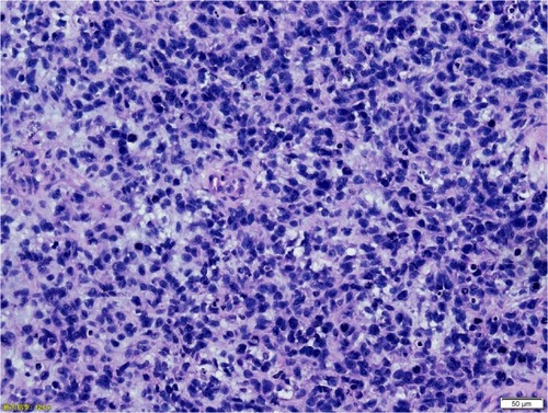 Figure 1 Histological section with haematoxylin and eosin staining, magnification, ×200. Primarily round and spindle cells, were identified to contain eccentric nuclei and deeply eosinophilic cytoplasm.