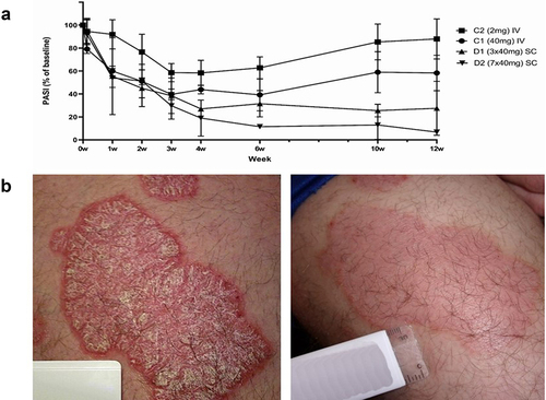 Figure 5. Clinical response to treatment with izokibep. (a)mean (SD) PASI score by week for patients with moderate-to-severe psoriasis (PASI≥12 at baseline). Patients received a single dose of 2 or 40 mg izokibep IV in part C2 and C1, respectively. In part D, patients received multiple doses izokibep SC Q2W 3 × 40 mg (last dose in week 4) or 7 × 40 mg (last dose in week 12). The on- and off-treatment effects are presented until week 12. (b) Psoriatic plaque lesion of selected individual patient prior to (left) and 14 days after (right) a single 40 mg IV dose of izokibep.