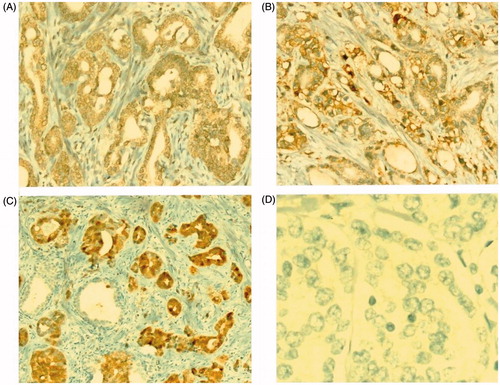 Figure 2. (A) Weak staining with EGFR in neoplastic glands (EGFRx200). (B) EGFR strong staining (EGFRx200). (C) Intense and strong staining with P16 in tumoral glands, negativity in the benign gland adjacent (P16 × 200). (D) No staining in neoplastic glands with HER2 (HER2 × 400).