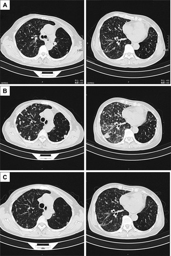 Figure 3 Thoracic computed tomography (CT) before taking gefitinib (A); after taking gefitinib, metastases increased widely in both lungs (B); after taking afatinib for one month, the metastases shrank obviously (C).