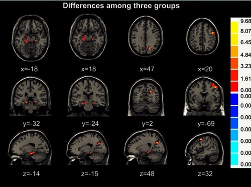 Figure 1 Regional GM volume differences in GI symptoms group, non-GI symptoms group and HCs group are displayed on axial, coronal and sagittal slices. Numbers indicate x, y and z slices and are displayed in MNI coordinates. Red color denotes increased GM volume. The color bars indicate the F-value based on one-way ANOVA in three groups. (voxel-P<0.01, cluster- P <0.05, cluster size>50, GRF correction).Abbreviations: GM, gray matter; HC, healthy control;  GI:  gastrointestinal symptom; GRF, Gaussian Random Field.