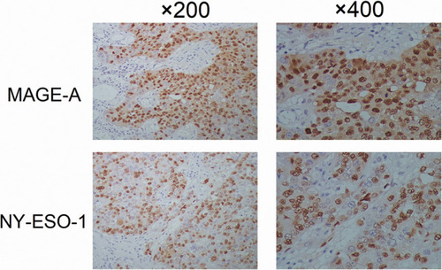Figure 1 Positive expression of MAGE-A/NY-ESO-1 in breast cancer tissues.