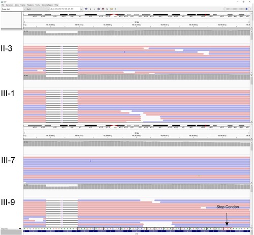 Figure 2. Identification of this truncation mutation c.7141_7151del in ATM. Visualization of ATM sequencing reads containing c.7141_7151del mutation using the Integrative Genomics Viewer (IGV). The big red box represents the 11 missing nucleotides. The small red box represents the stop codon.