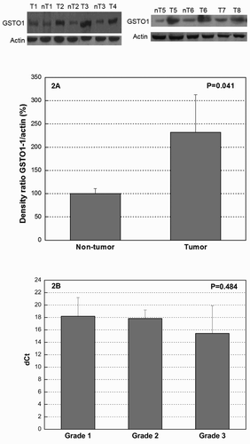 Figure 2. (a) Western blot of GSTO1 expression in TCC tumor and non-tumor tissue. Total amount of protein per sample (40 μg) was separated by SDS/PAGE and analyzed with monoclonal anti-GSTO1 antibody. Equal loading of total protein amount was ensured by β-actin. Proteins were densitometrically quantified and expressed as the mean percentage increase or decrease, compared to β-actin ± SD (graph). Differences in the variables between groups were assessed by the t-test. A P value of <0.05 was considered statistically significant. For western blots reported in the figure, the representative samples are shown. (B) RT-PCR analysis of GSTO1 expression in TCC according to the tumor grade. Total RNA was extracted from TCC tissue specimens and subjected to RT-PCR. Data were normalized by the 18S ribosomal RNA expression levels in each sample and presented as mean dCt ± SD of three independent RT-PCR analyses. Ct levels are inversely proportional to the amount of target GSTO1 in the sample (i.e. the lower the Ct level the greater the expression of target GSTO1 in the sample). dCt, delta threshold cycle.