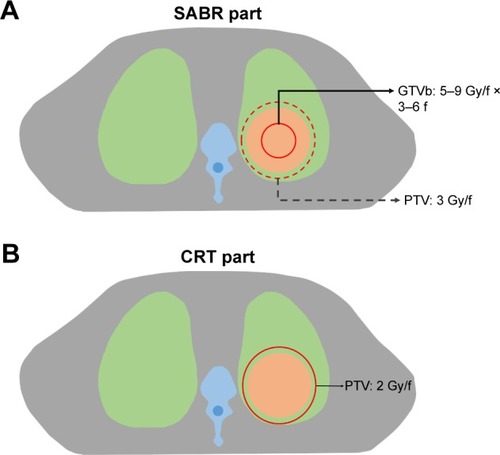 Figure 1 Schematic diagram of the P-SABR. The P-SABR plan combines a partial SABR boost plan and a CRT plan. (A) The SABR (5–9 Gy per fraction) was delivered to the max tumor volume, while the OAR dose fell off to 3 Gy/f. (B) The CRT component was delivered afterwards, ensuring the total PTV margin dose to about 64 Gy.