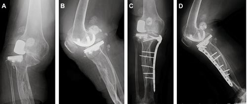 Figure 6 Postoperative (A) anteroposterior and (B) lateral tibial plateau lesion diagnosed as an oblique fracture of the proximal tibia. (C) Anteroposterior postoperative radiograph of the distal tibia locking plate indicating adequate fixation. (D) Lateral postoperative radiograph of the distal tibia locking plate indicating adequate fixation.