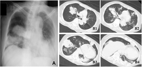 Figure 1 Radiological findings of the present case. Chest X-ray revealing lobar pneumonia on bilateral lung fields (A). Computed tomography showing multiple consolidation with air-bronchogram, nodules, and ground-glass attenuation on bilateral lung fields (B1–4).