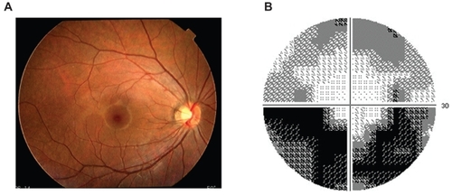 Figure 1 Case 1 Findings in a 23-year-old woman with AZOOR at onset (kindly provided by Professor Hiroyuki Iijima of Yamanashi University Hospital). A) Fundus photograph of posterior pole of the right eye. Fundus appears normal. B) Visual field defect characterized by enlargement of blind spot and deep scotomas in the inferior and nasal visual field of her right eye.